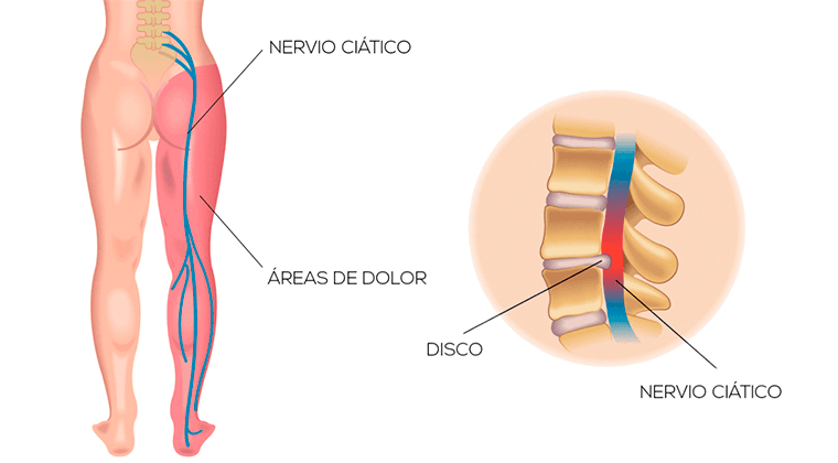 Ciática