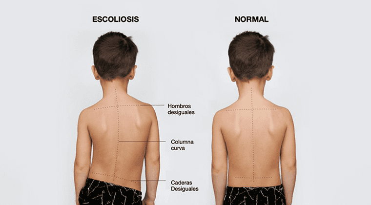 Escoliosis