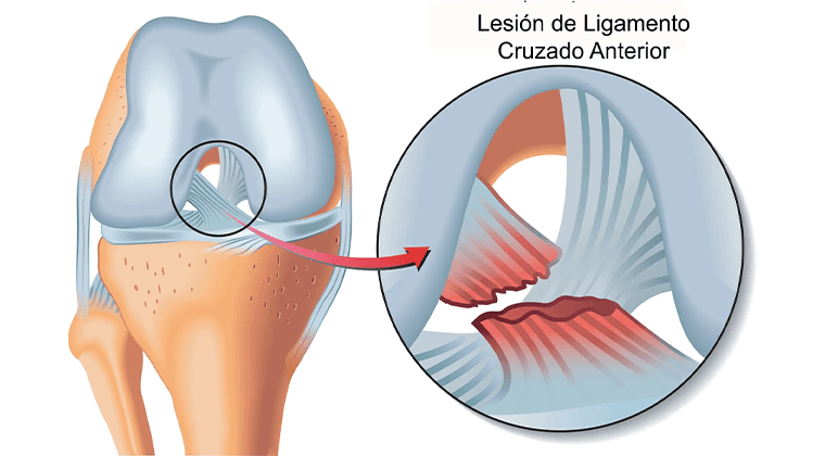 Lesiones de Ligamento Cruzado