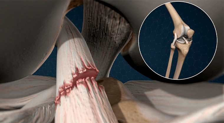 Lesiones de Ligamentos