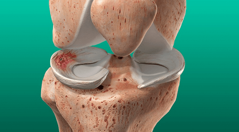 Lesiones Meniscales