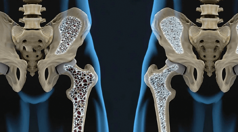 Osteoporosis con Fracturas por Fragilidad