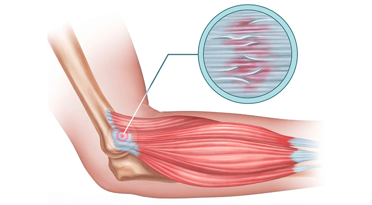 Tendinitis