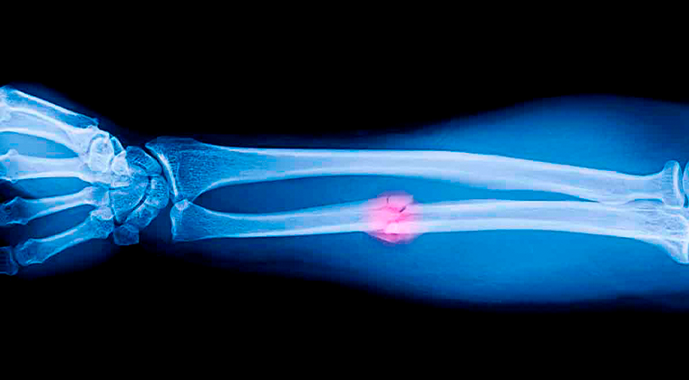 Imagen de Fracturas Óseas