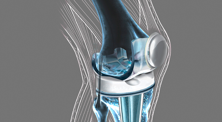 Prótesis de Rodilla
